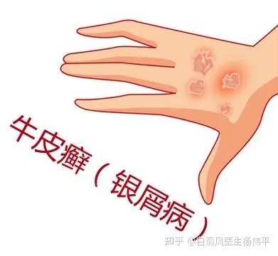 慢跑对牛皮癣治疗有帮助吗