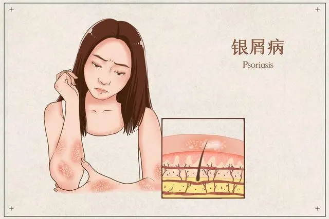 什么是关节型牛皮癣