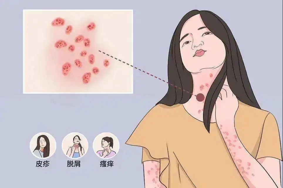 了解牛皮癣的发病原因，积极预防疾病