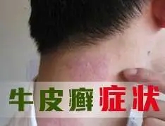 牛皮癣常见症状知多少