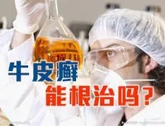 牛皮癣怎么治疗有效