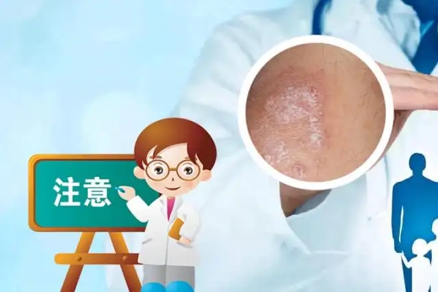 牛皮癣的出现是谁造成的