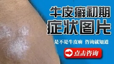 牛皮癣早期有哪些症状