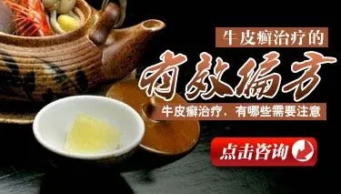 寻常型牛皮癣治疗有哪些民间食谱