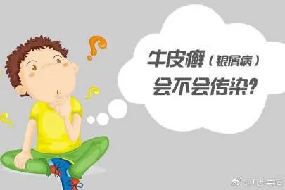 牛皮癣会传染吗